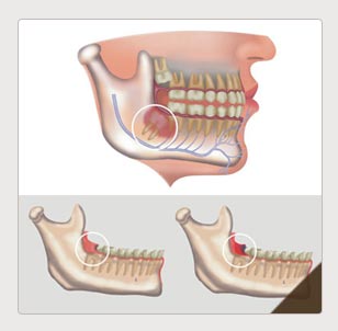 智齿冠周炎引起的牙痛